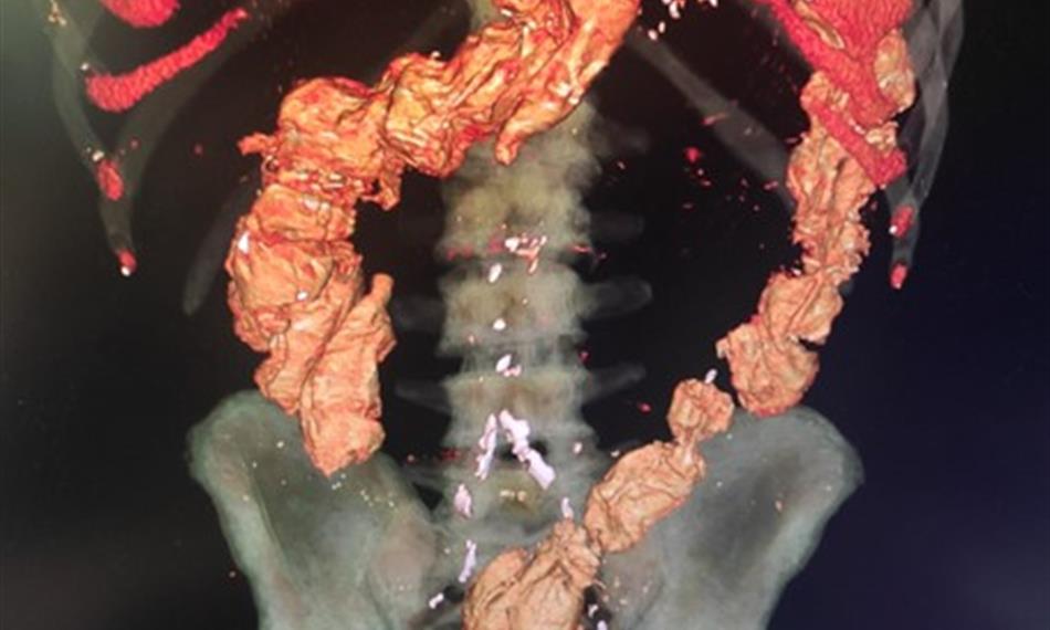 polykač - trávicí trakt